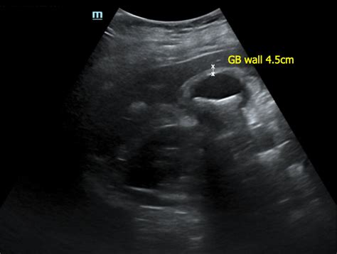 how to measure gallbladder wall thickness on ultrasound|gallbladder wall thickening on ultrasound.